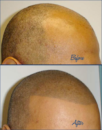 Even with hair tattoo. Hair follicle replication is a form of medical 